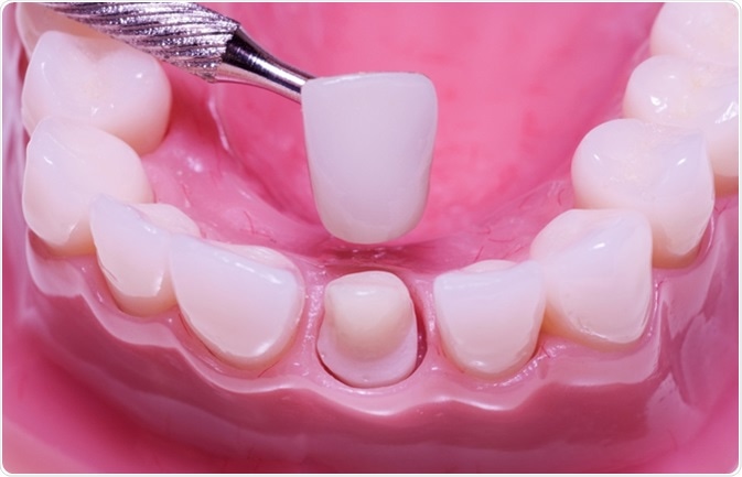 How Dental Crowns Can Restore Your Smile After Tooth Damage Dental Crowns