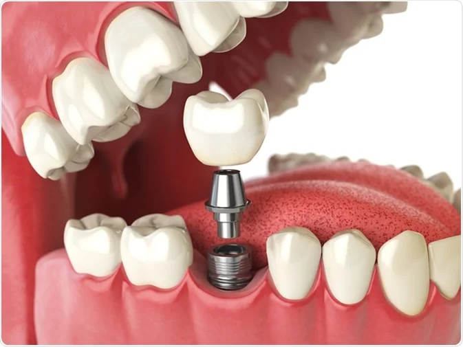 Understanding the Benefits of Dental Implants for Missing Teeth Dental Implants for Missing Teeth