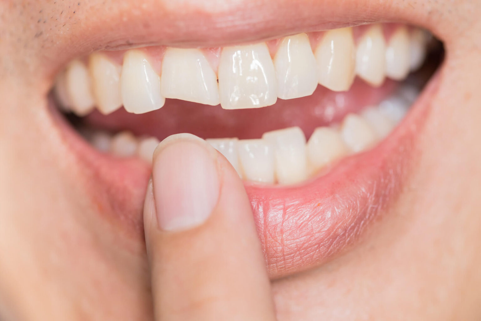 Managing Pain After a Broken Tooth