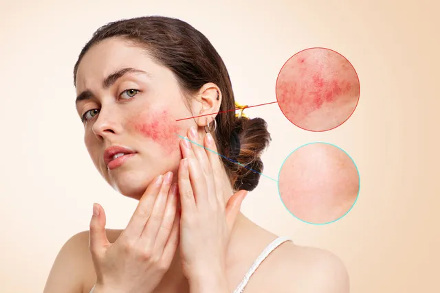 Managing Rosacea and Wart Symptoms Effectively Managing Rosacea and Wart Symptoms