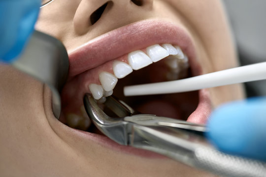 Understanding the Role of Dental Extractions in Oral Health Role of Dental Extractions in Oral Health