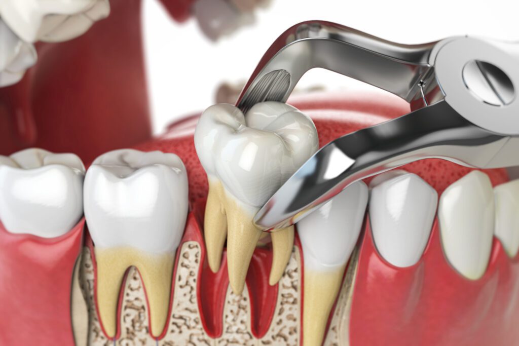 Tips for Preparing for the Tooth Extraction Process Tooth Extraction Process