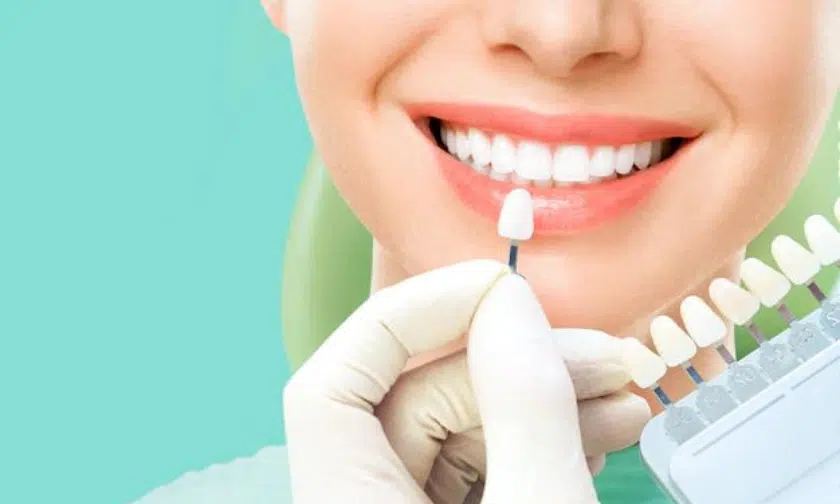 Understanding if Veneers Are Right for You Veneers