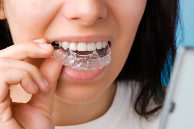 Why Clear Braces Are a Good Choice for Adults clear-braces